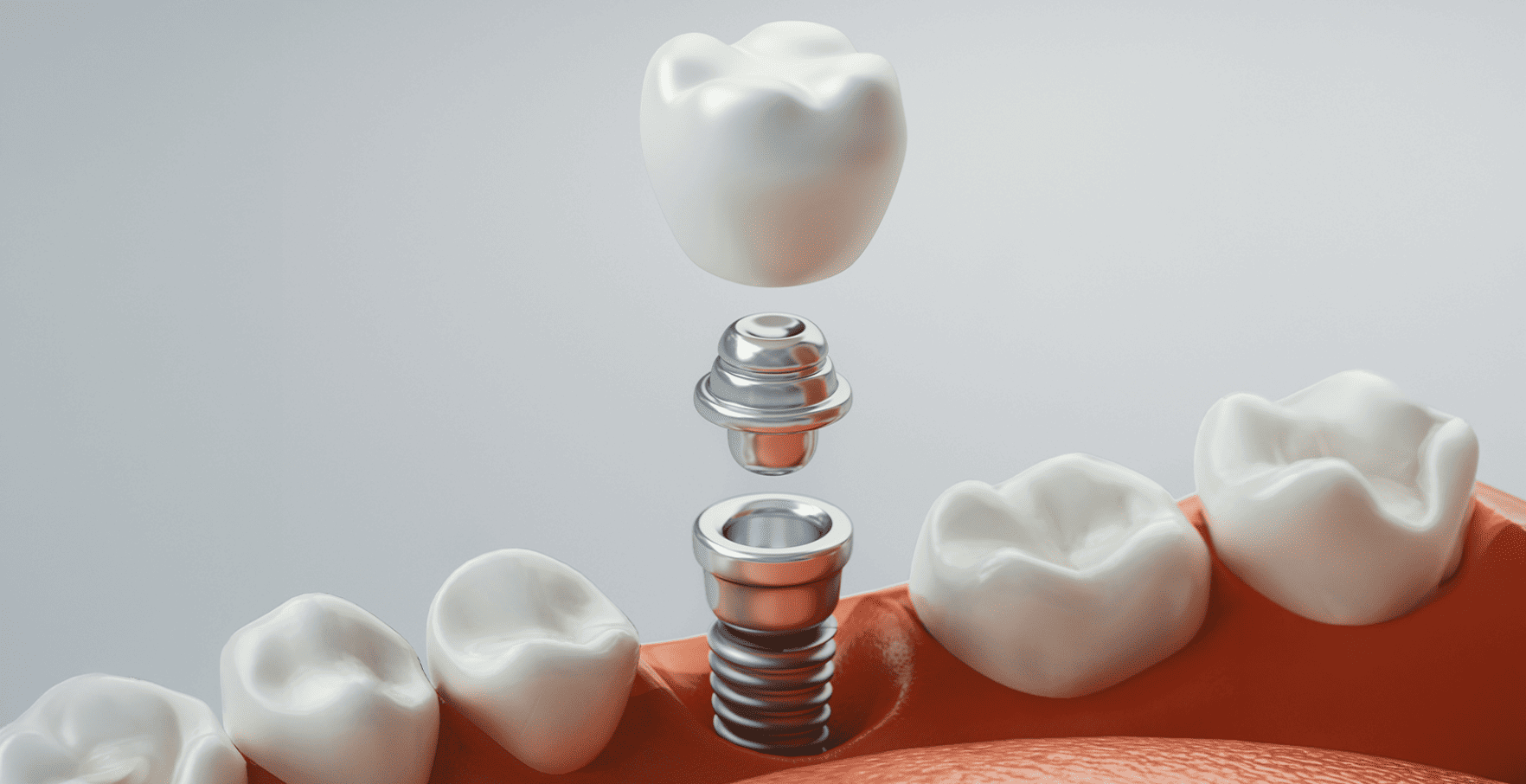 Dental Implant